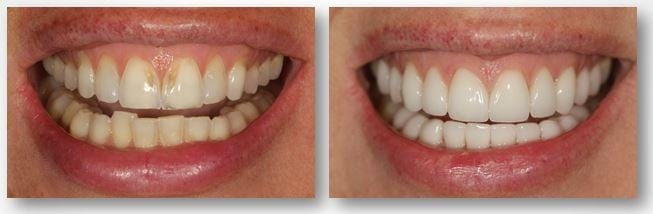Understanding Enamel Loss and Dental Bonding