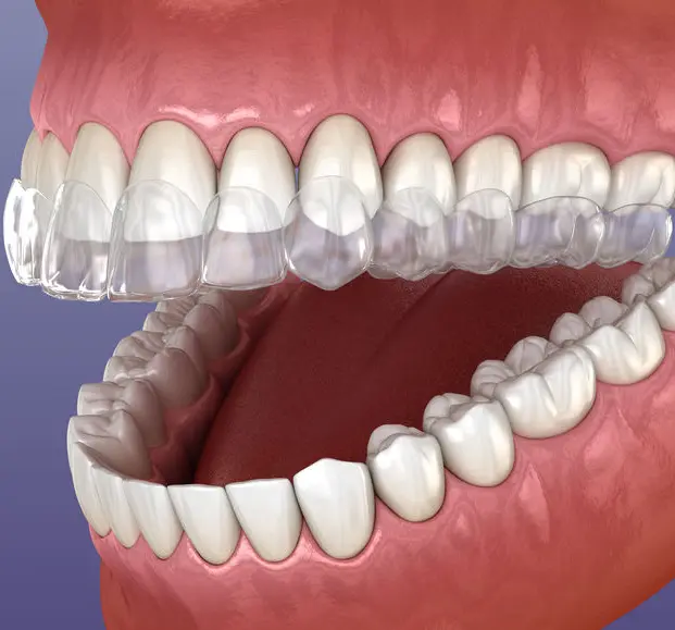 Everything You Need to Know About Clear Aligners