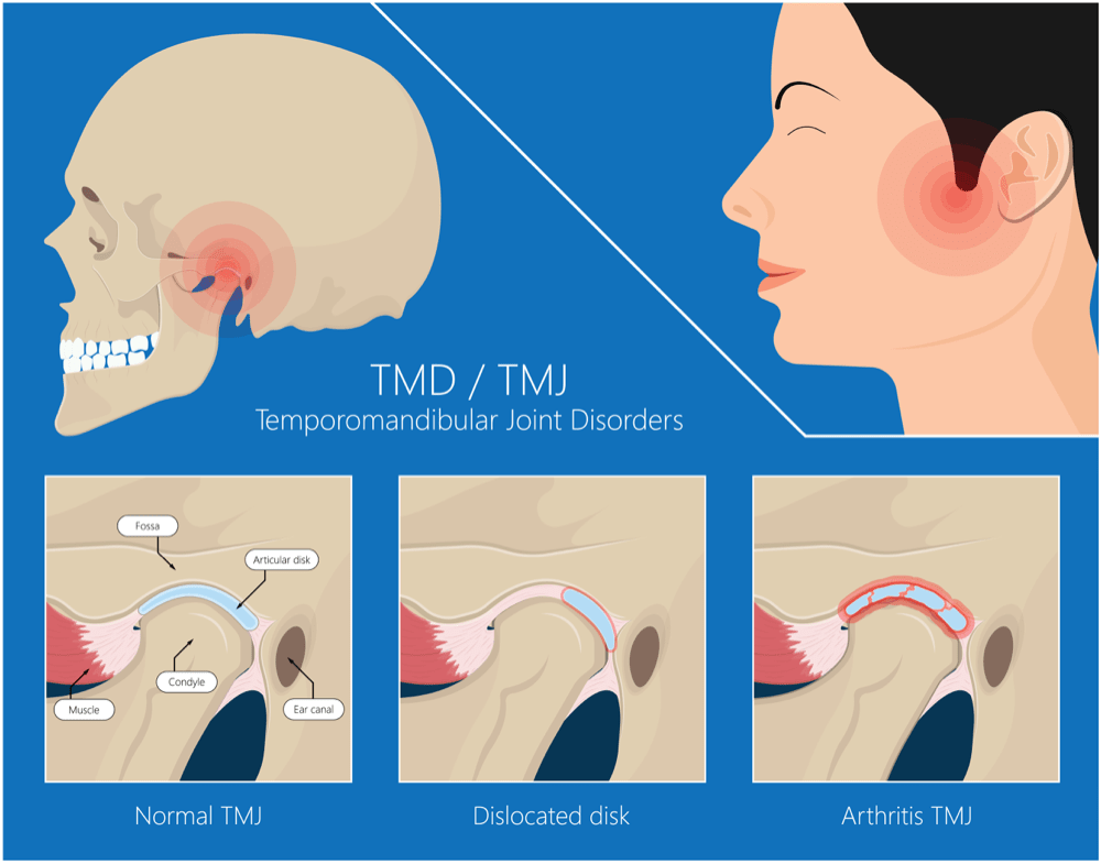 Struggling with Jaw or Facial Pain?