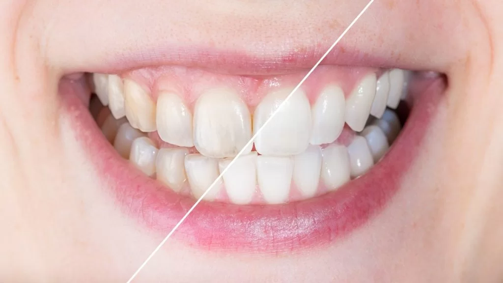 What can cosmetic bonding fix?