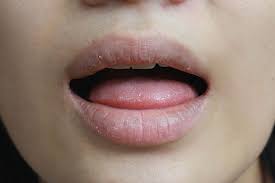 Understanding Dry Mouth (Xerostomia)