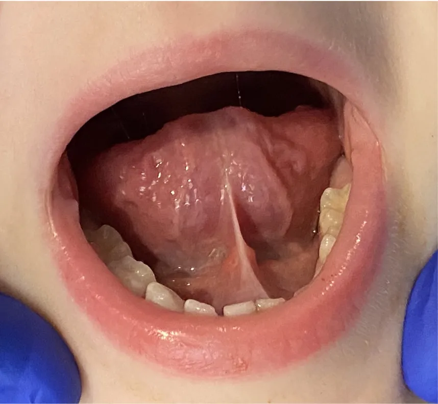 Tongue-Tie (Ankyloglossia)