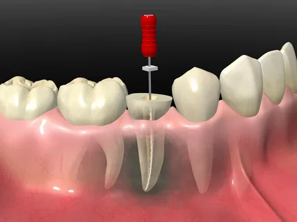 Root Canal Therapy: Saving Your Natural Tooth