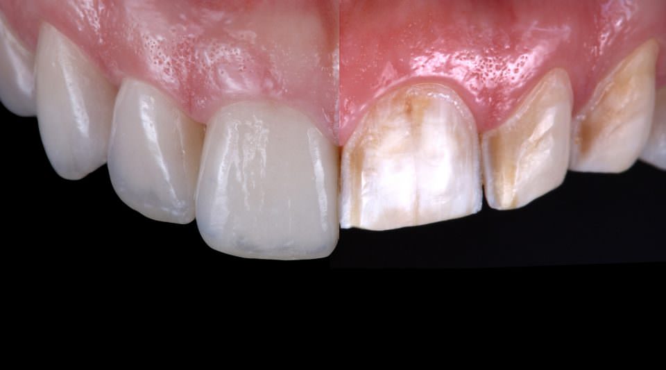 What Are Direct Veneers?