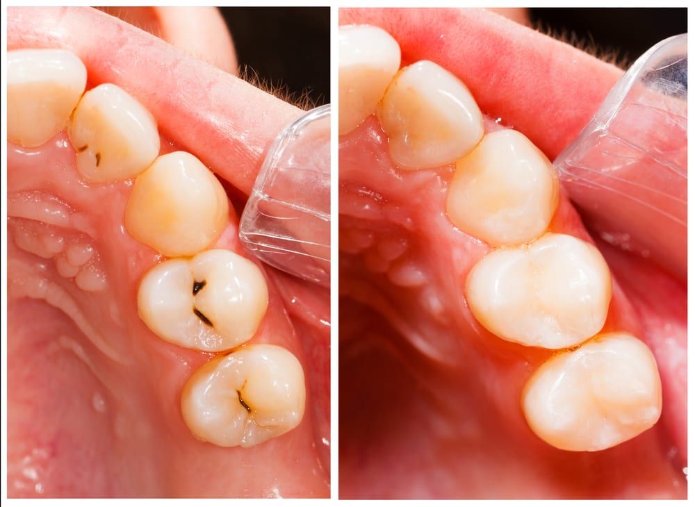 The Surprising Environmental Benefits of Choosing Composite Fillings