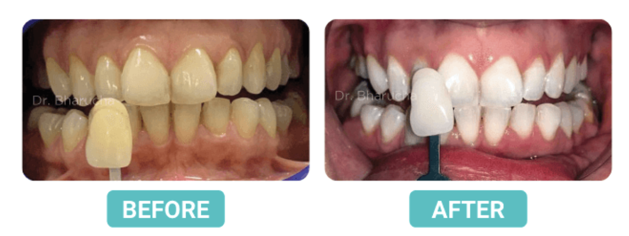 Boost confidence with Teeth Whitening
