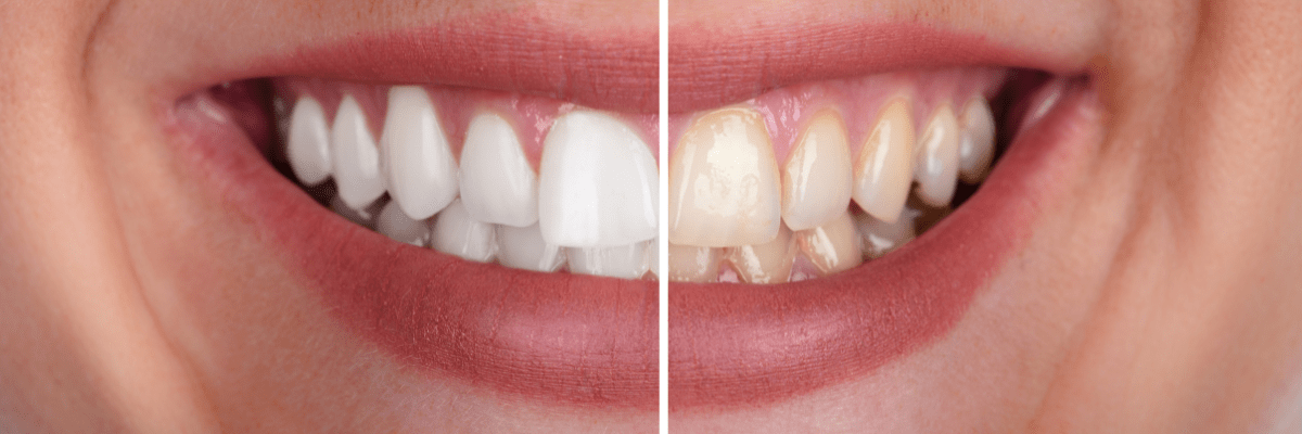 Boost Your Confidence with Teeth Whitening
