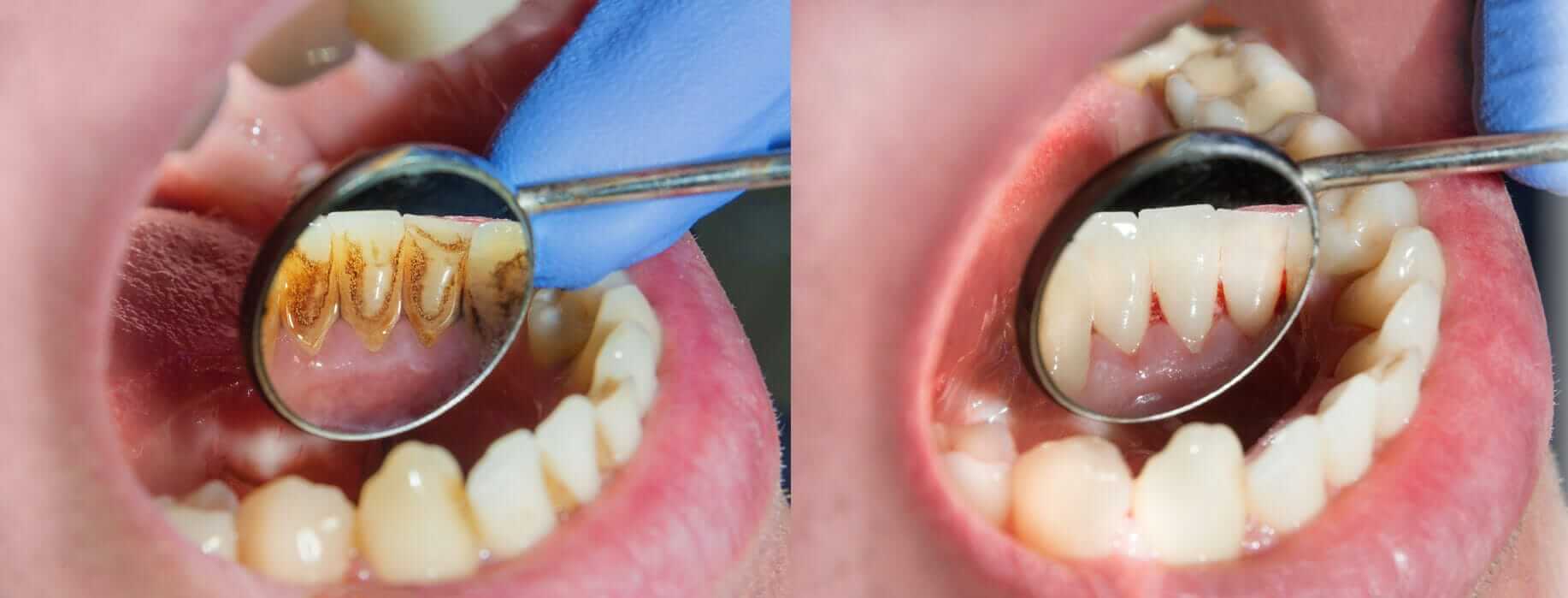 Bleeding Gums? Learn about Periodontal Treatment