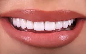 Veneers, Cost, And Equity In Dental Care