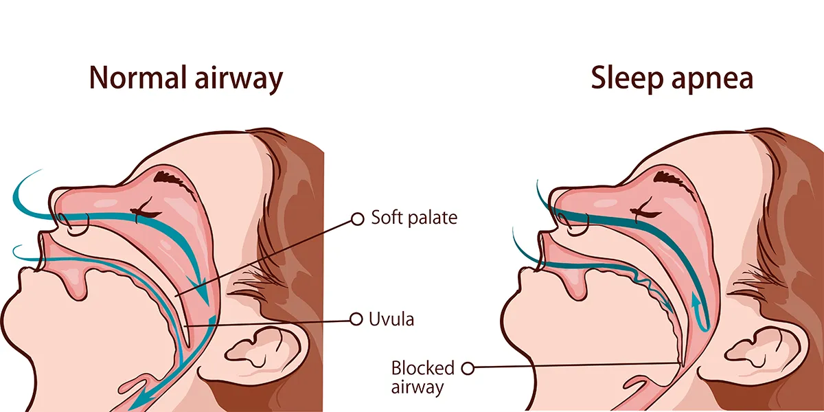 Sleep Apnea