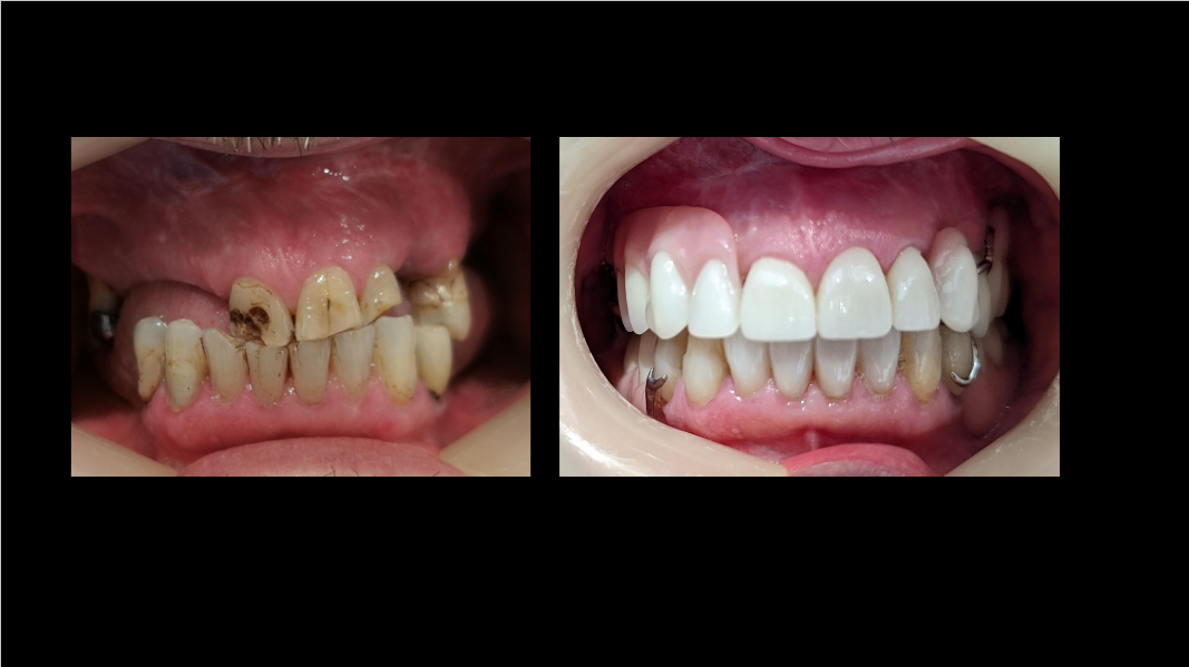 Restoring Smiles with Flexible Dentures and Fixed Partial Dentures