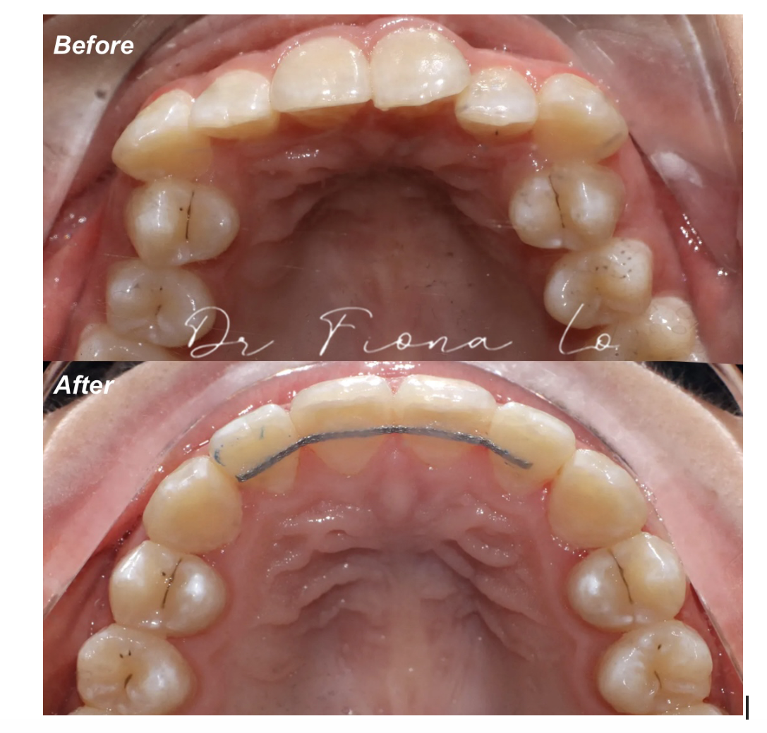 Why Retainers Are Essential After Orthodontic Treatment