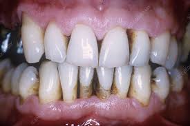What Are Receding Gums?