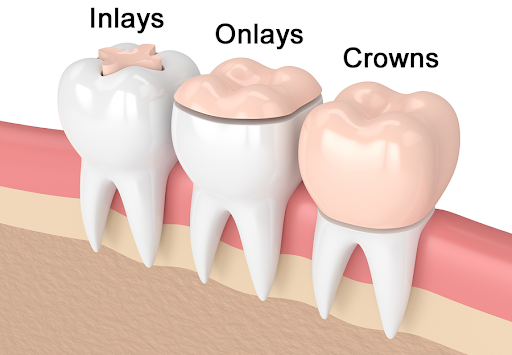 What Are Inlays and Onlays?