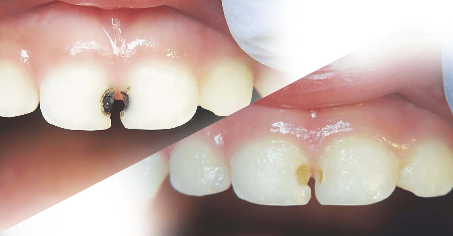 Silver Diamine Fluoride in Pediatric and Geriatric Dentistry