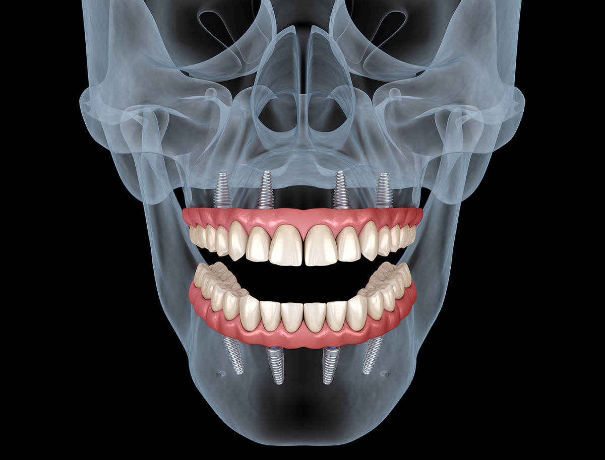 All-on-4 Dental Implants FAQs
