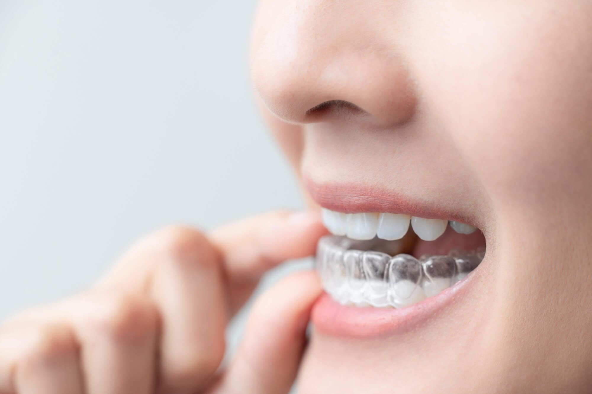 Are you a Candidate of Invisalign? 