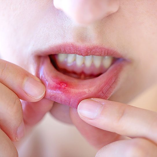 How to Treat Them Canker Soars and what Causes Them