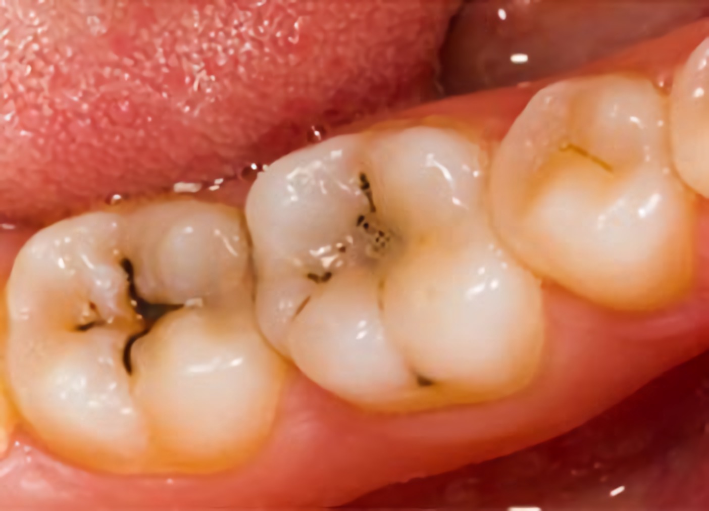 Dental Caries: Causes, Prevention, and Treatment