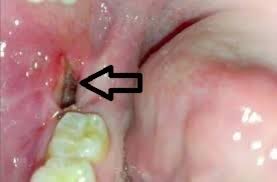 What Is a Dry Socket?