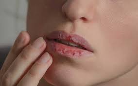 How Xerostomia or Dry Mouth affects our lifestyle