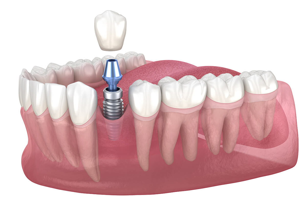 Dental Implants