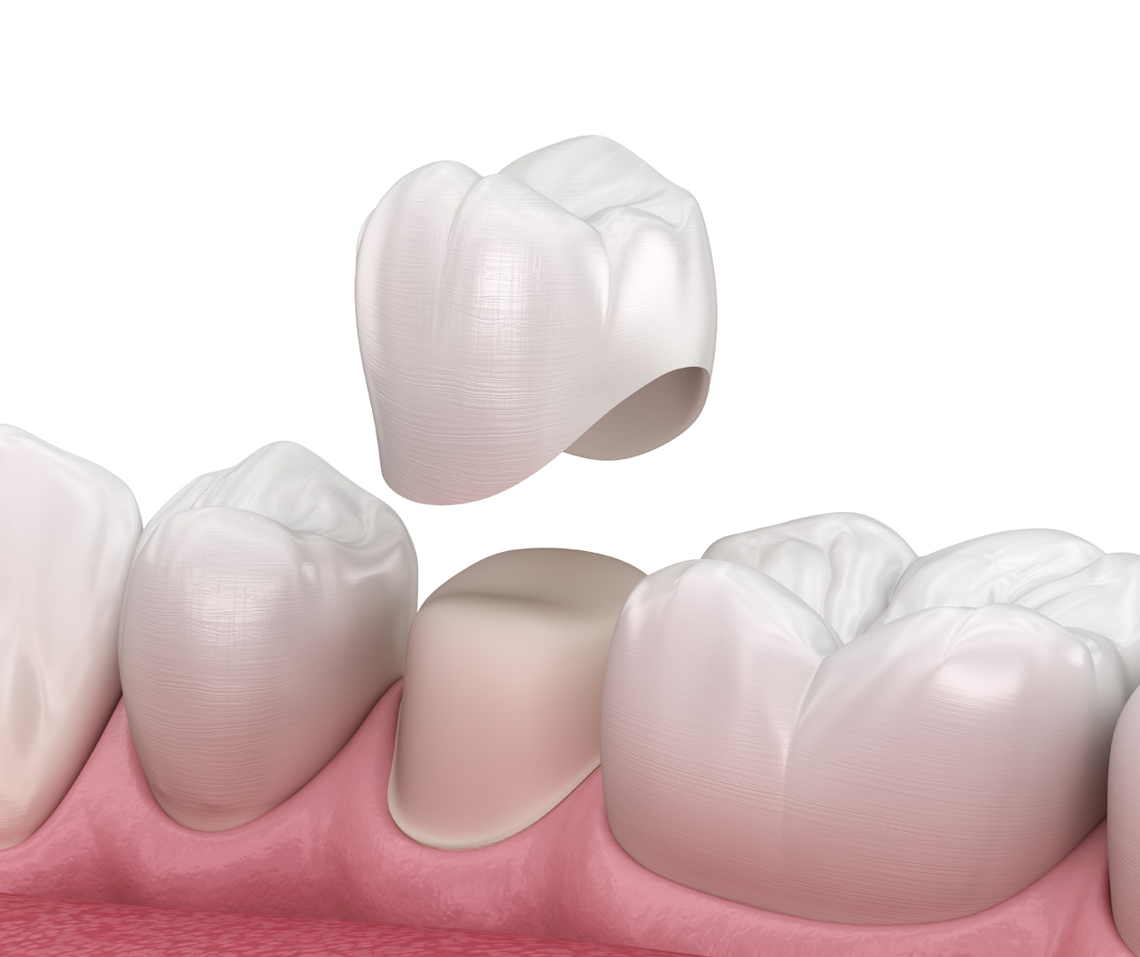 Dental Crowns: Strengthen, Protect, and Restore Your Smile