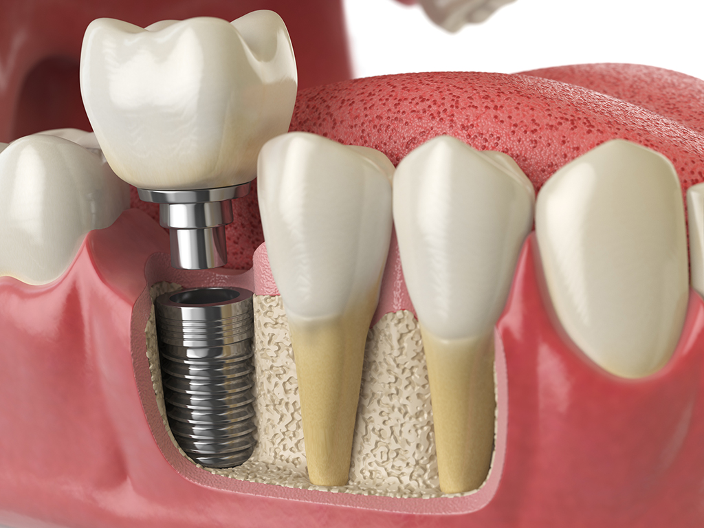 What Is a Dental Implant?