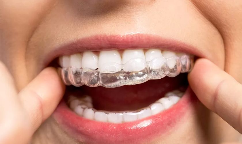 Why Patients Love Invisalign