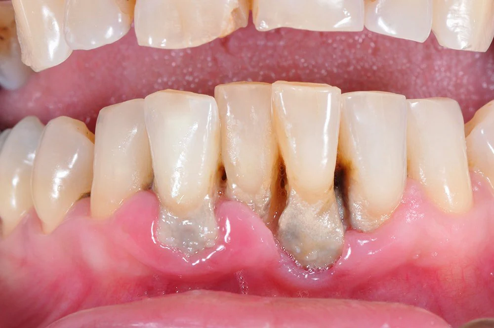 Periodontal Treatment: Gentle Care for Healthier Gums