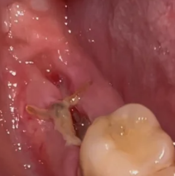 Understanding Blood Clot Tendencies in Dentistry