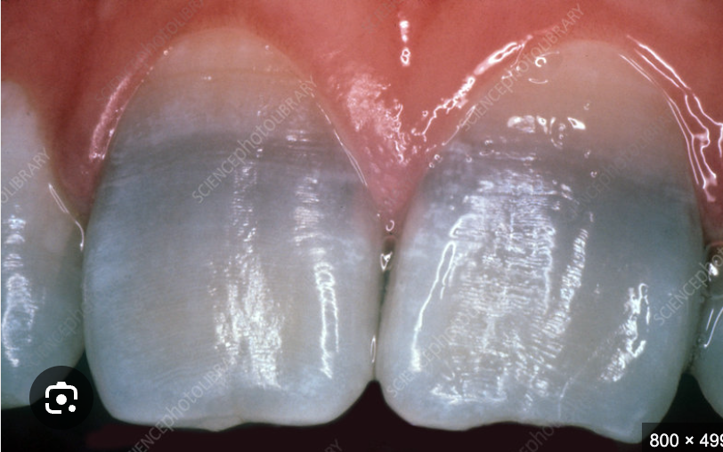 What Are Tetracycline Stains on Teeth?