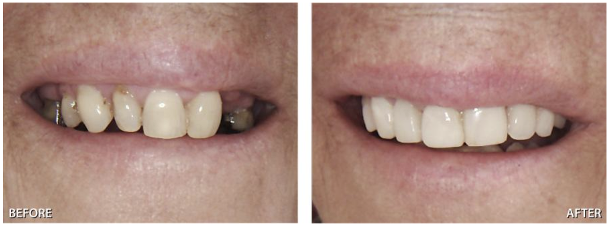 More to know about a  Removable Partial Denture