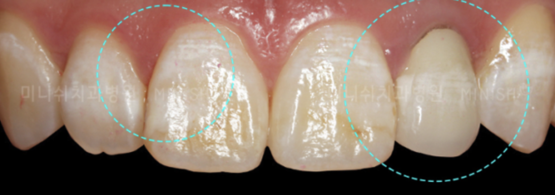 Is there a White Spot Lesion on your teeth? Might want to read this! 