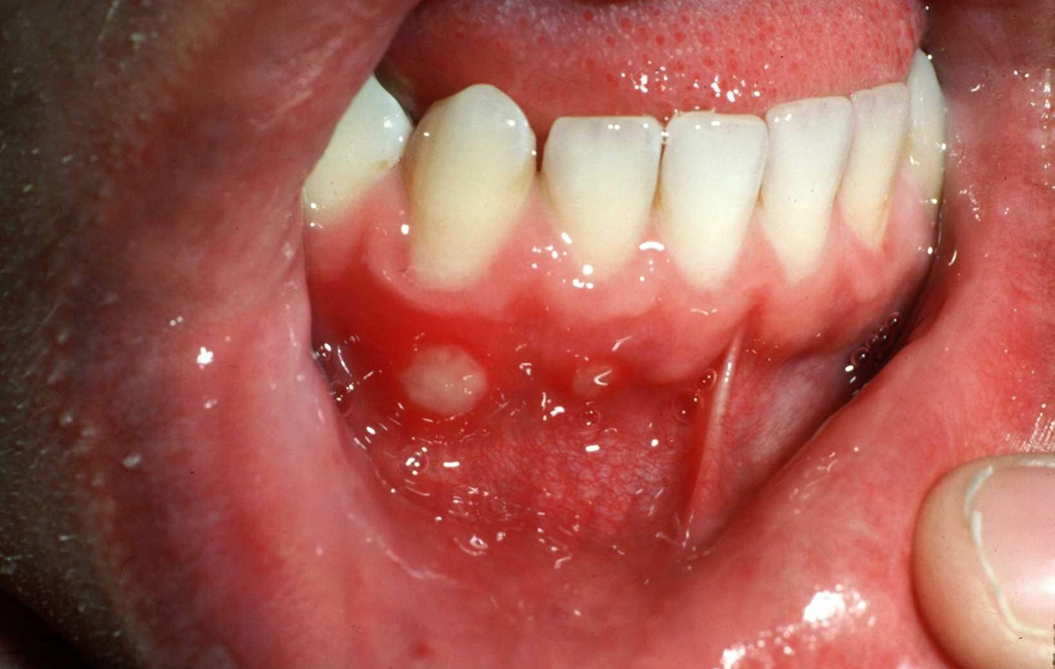 Ever had a painful sore inside your mouth?