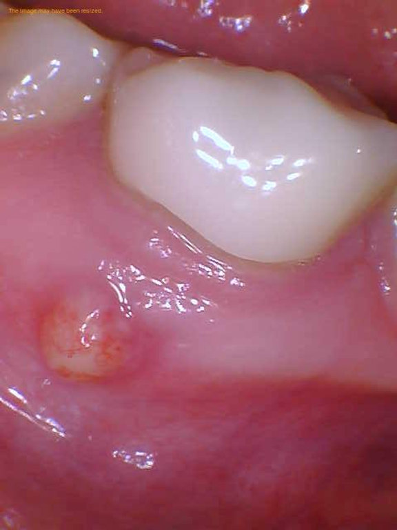 Did you ever notice a small swelling or bump on your gums?