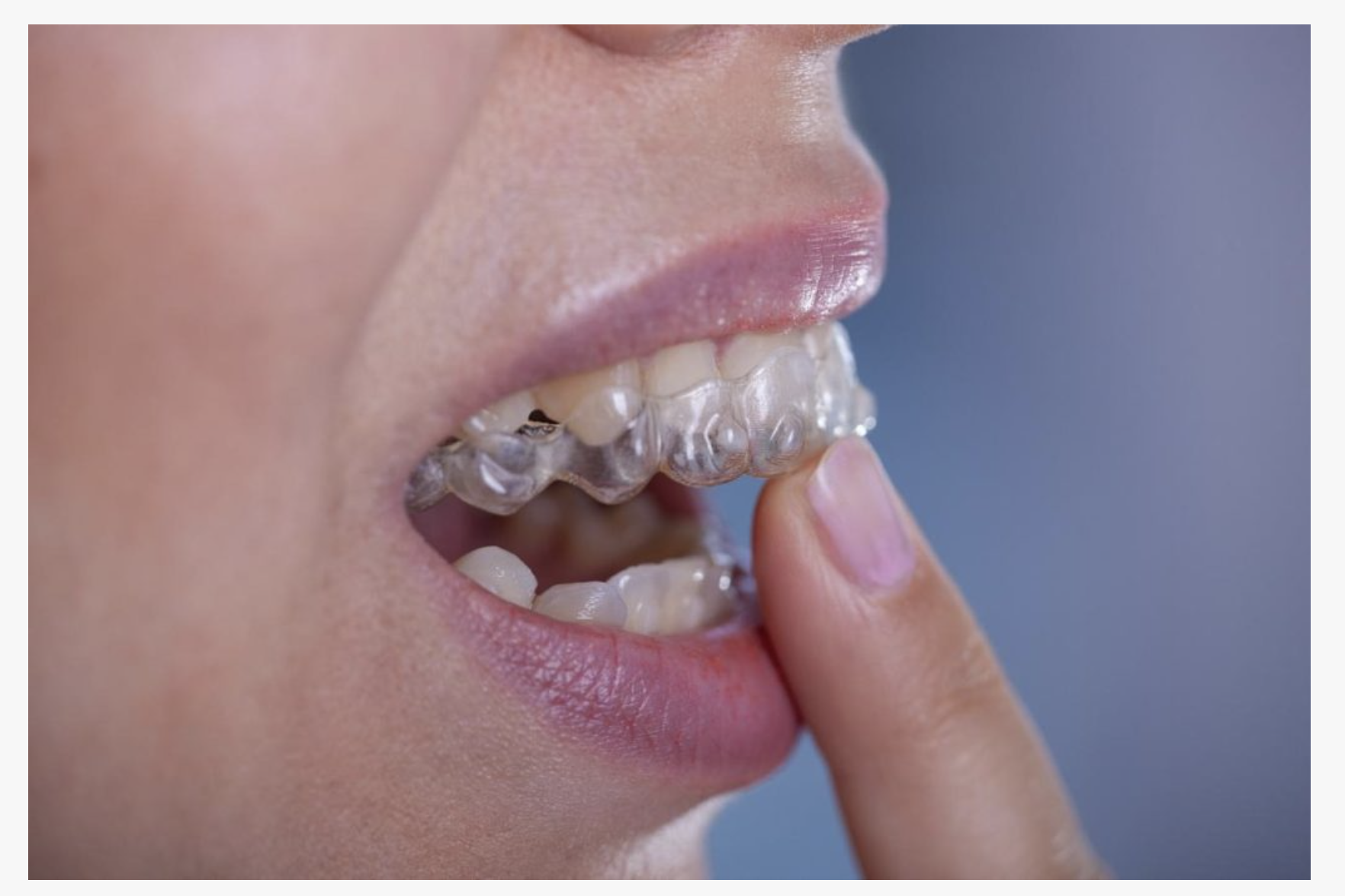  Try our Invisalign!