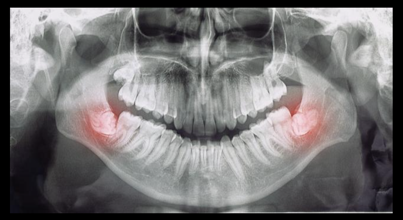Why Do Wisdom Teeth Cause Problems?