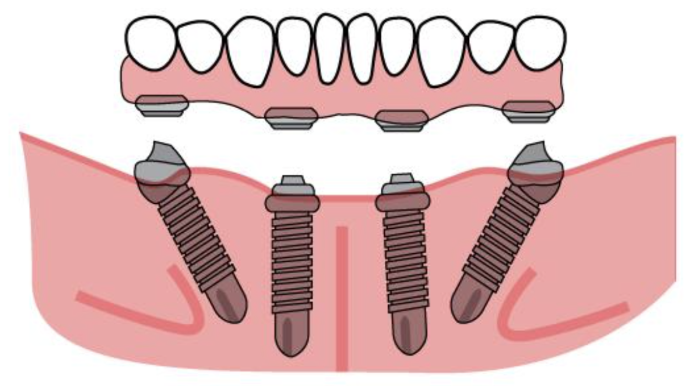 All-on-4 Dental Implants: Treatment Overview