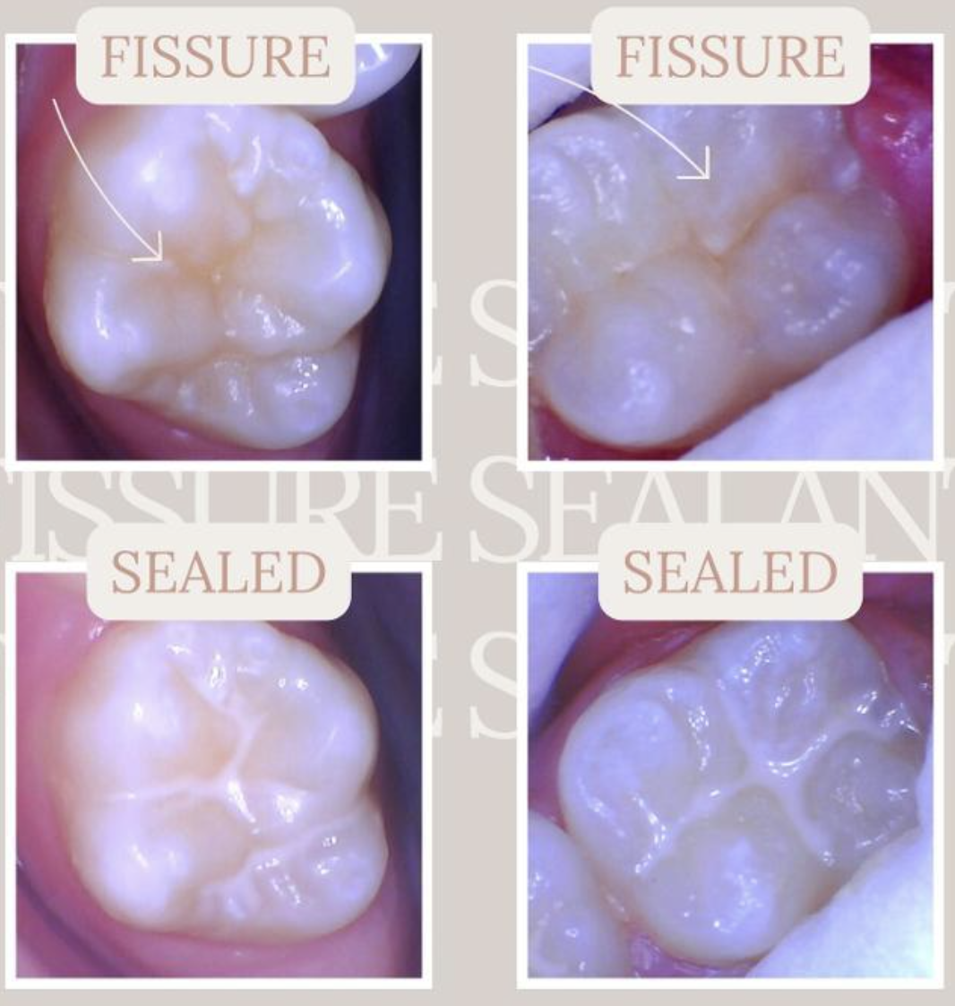 KNOW MORE ABOUT FISSURE SEALANTS