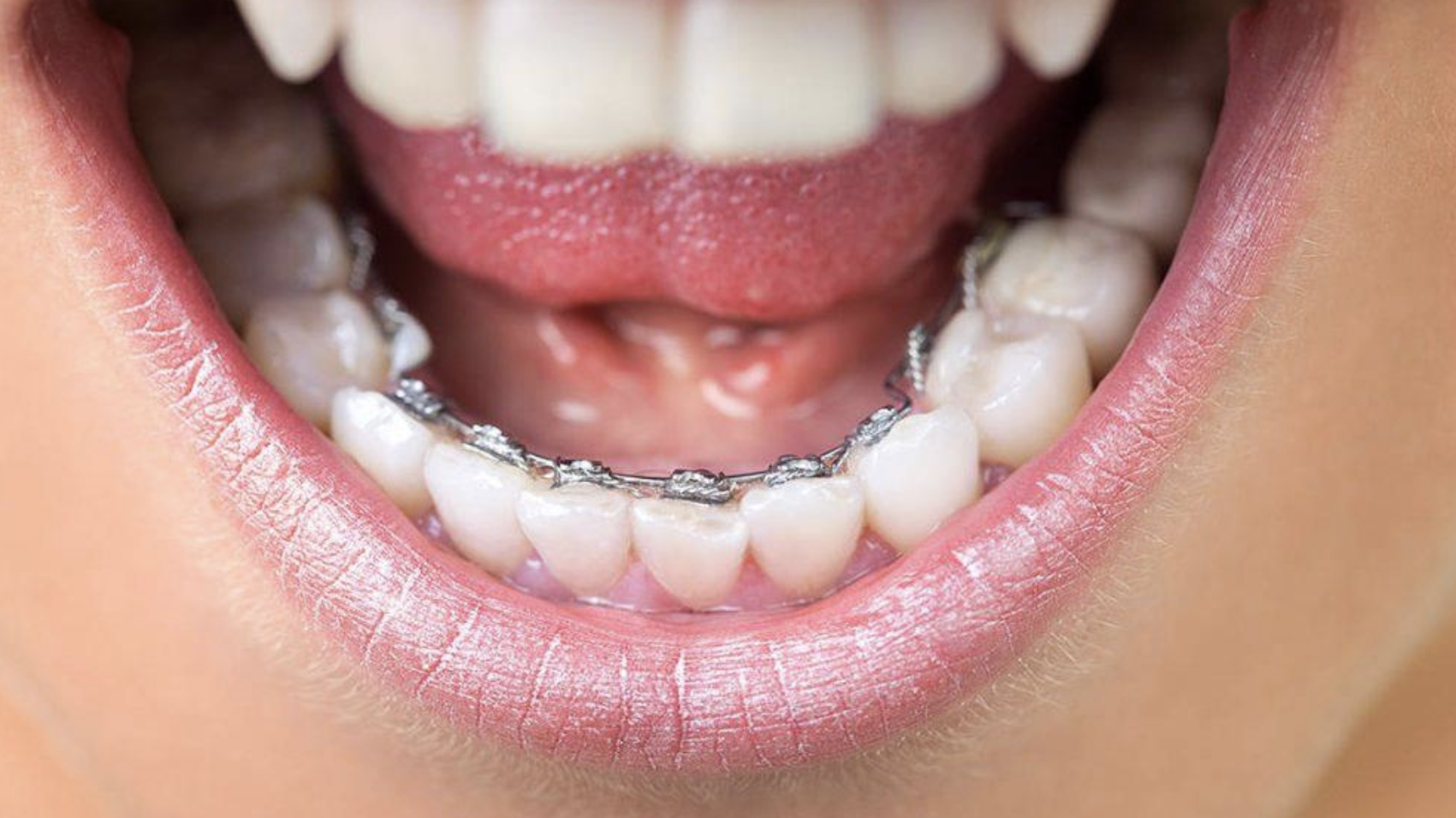 What About Lingual Braces? 