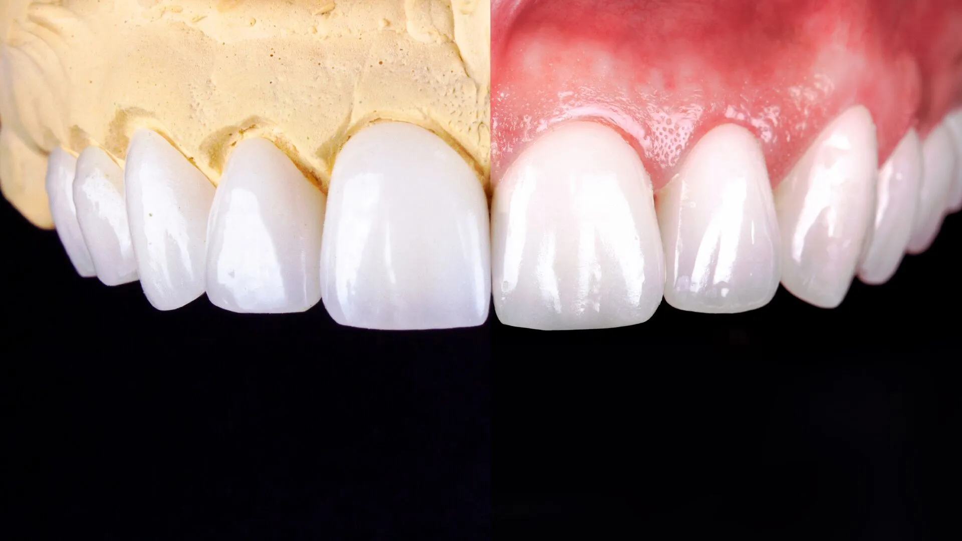 Composite Veneers