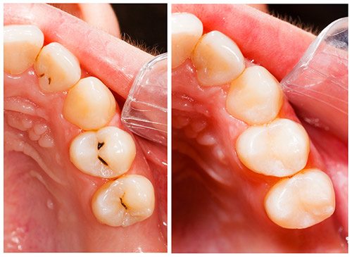 Why Are Restorations Important?