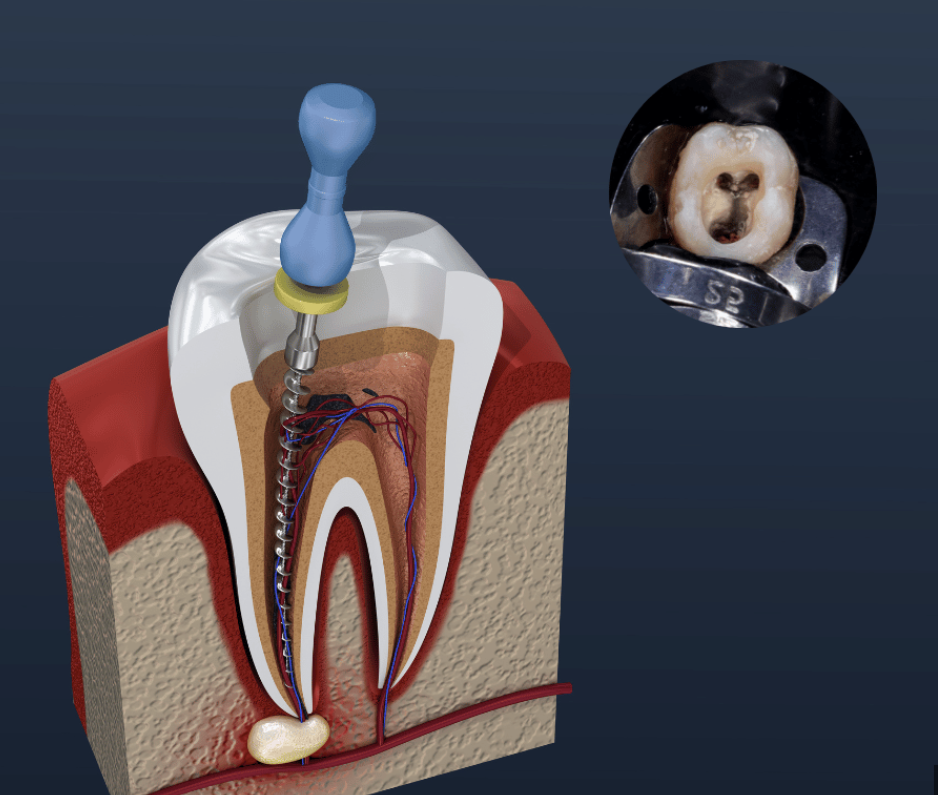 The Biggest Myth About Root Canals