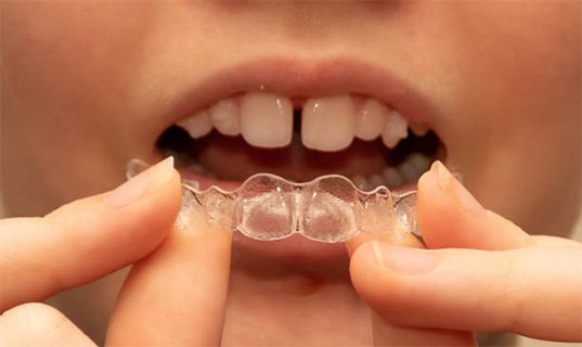 Braces vs Invisalign: What’s Changed in Orthodontic Treatment?