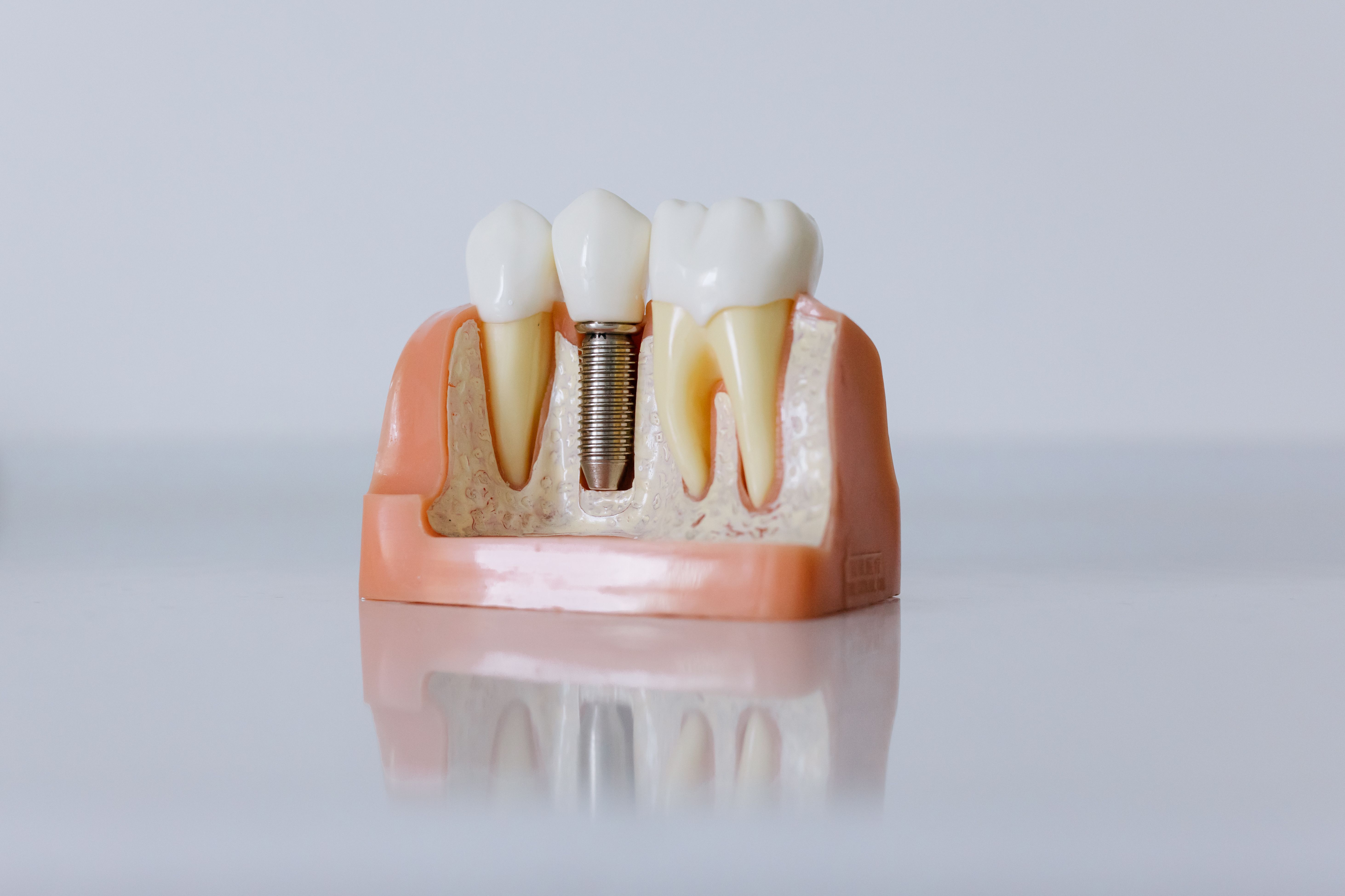 What Is a Single Dental Implant?