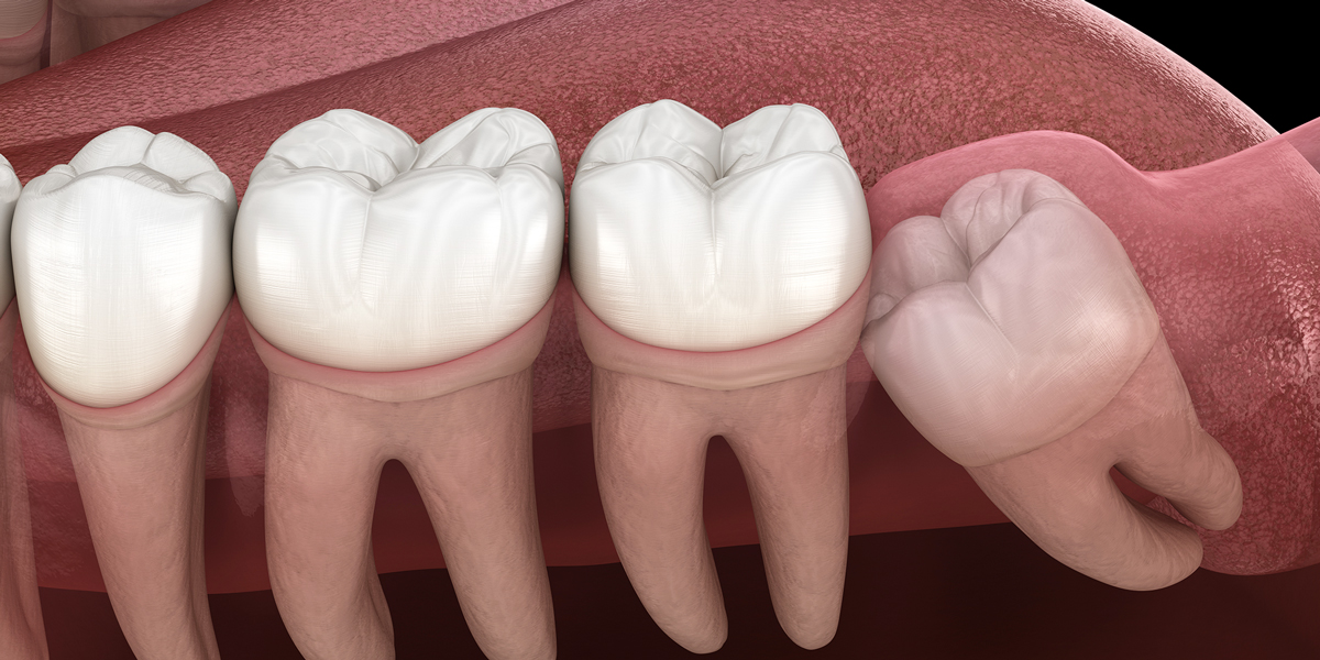 Impacted teeth need surgery 