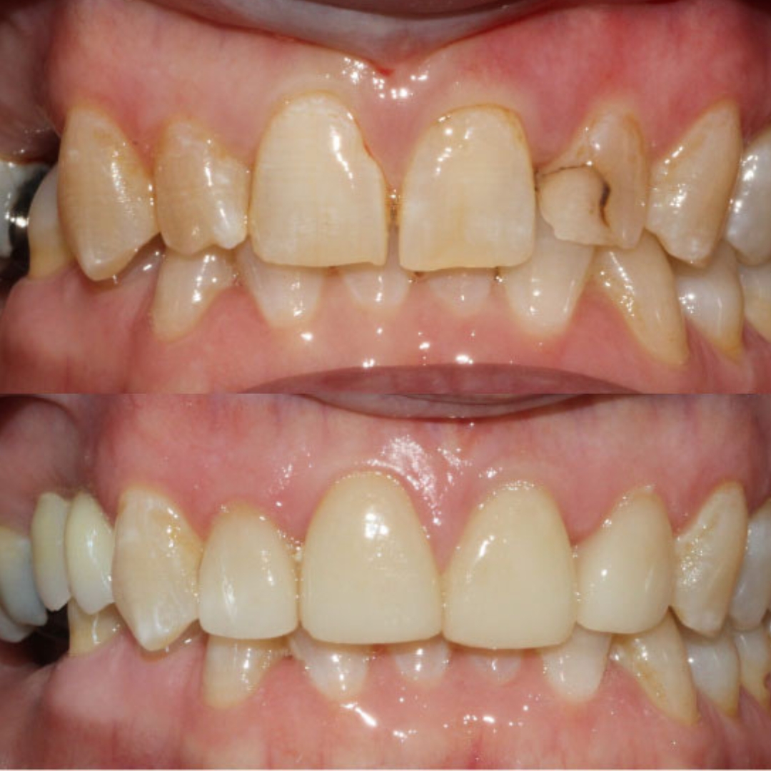 Before and After Veneers: A Smile Transformation