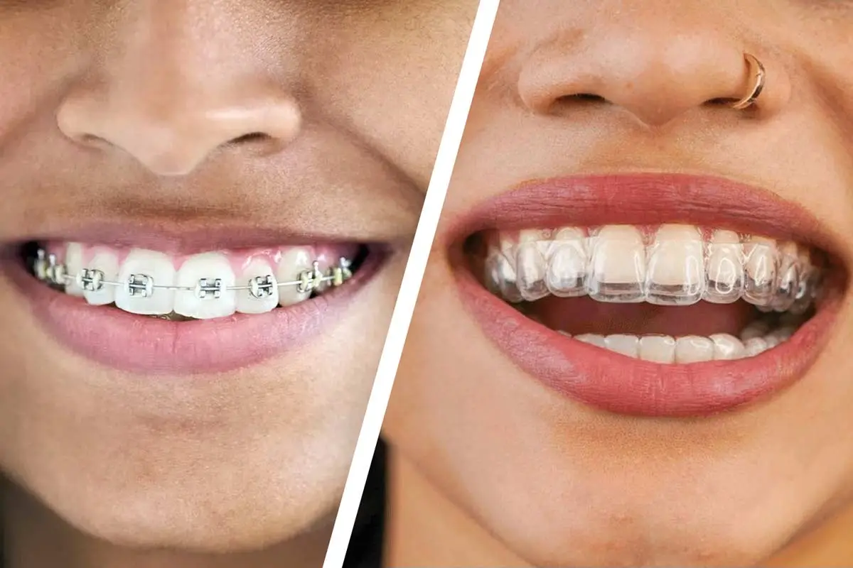 What Makes Invisalign Different?
