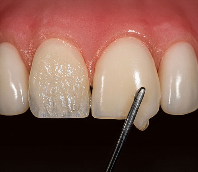 What can Direct Veneers do to our teeth?